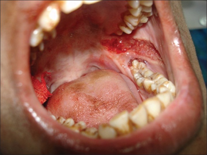 Fibrosis submucosa oral