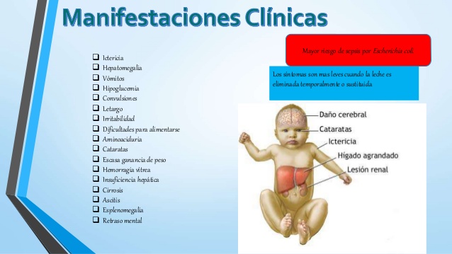 Deficiencia de galactoquinasa