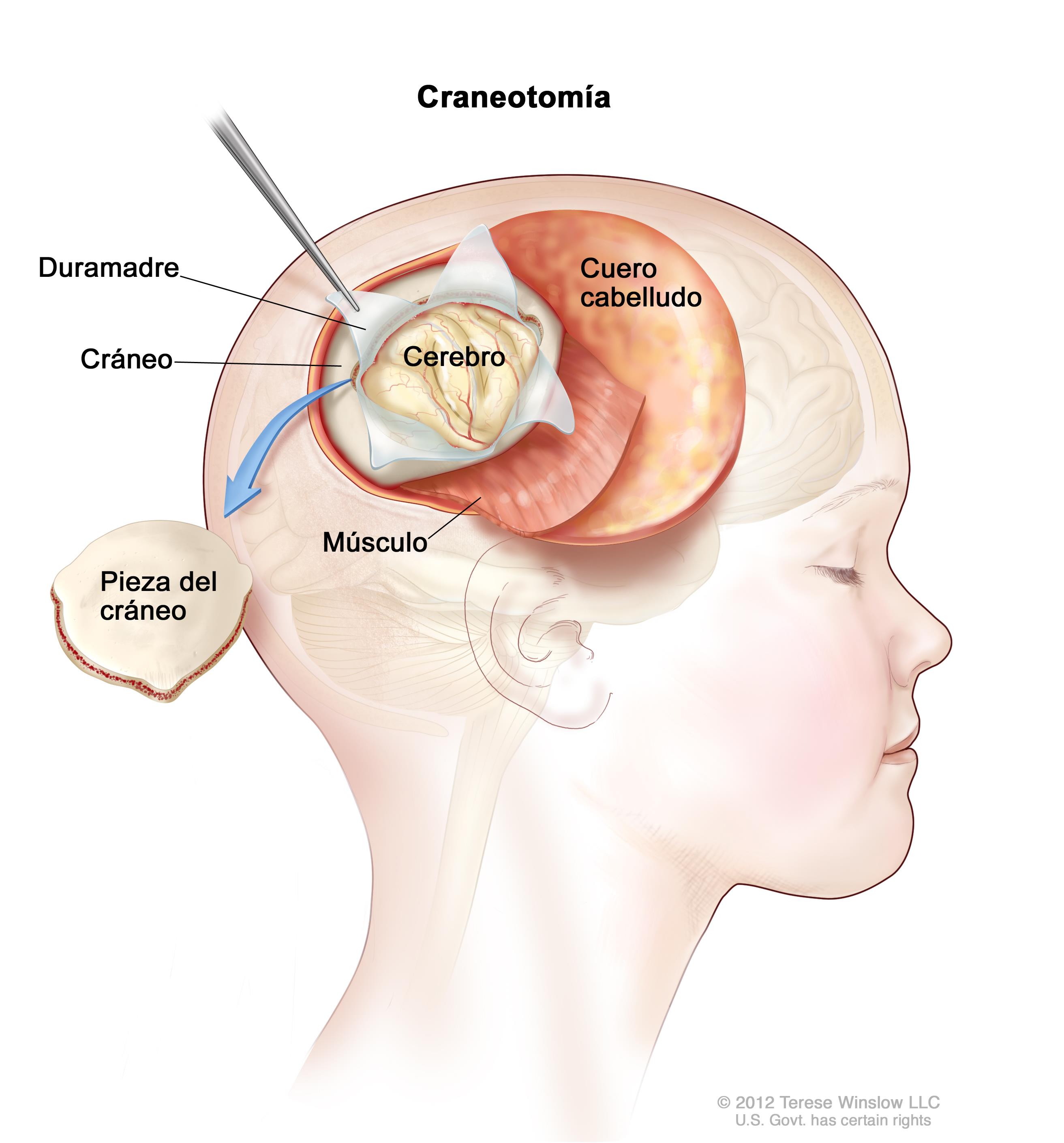 Glioma angiocéntrico