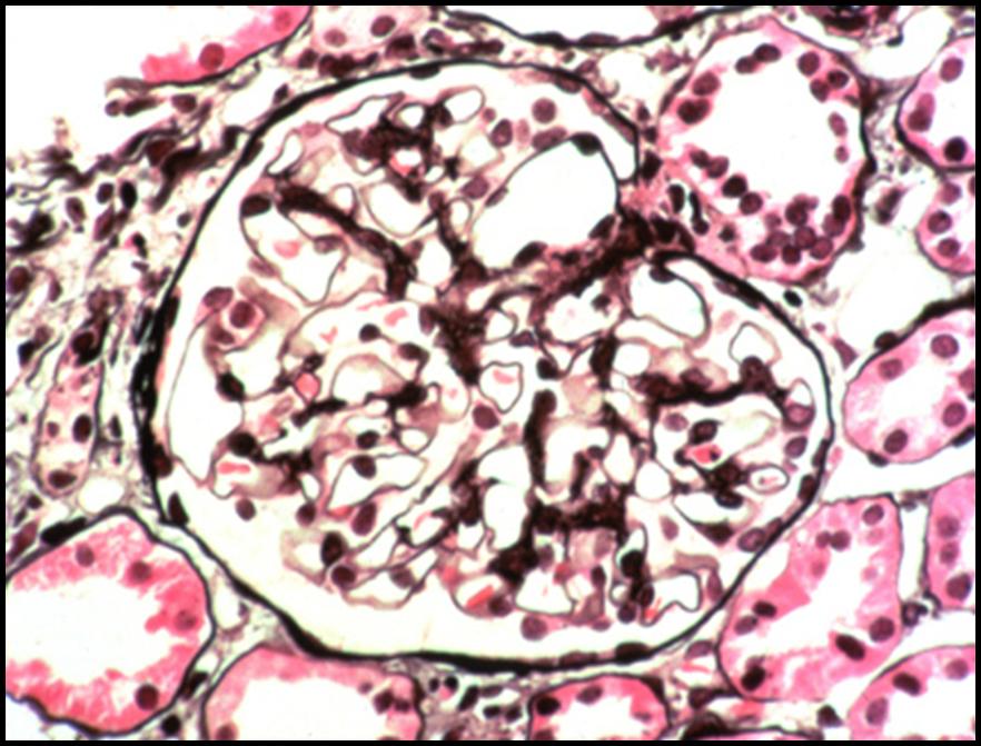 Glomerulopatía inmunotactoide