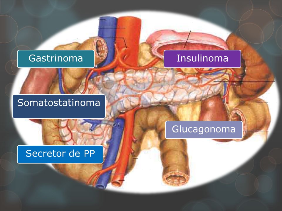 Glucagonoma