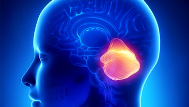 Hipomielinización con atrofia de los ganglios basales y del cerebelo