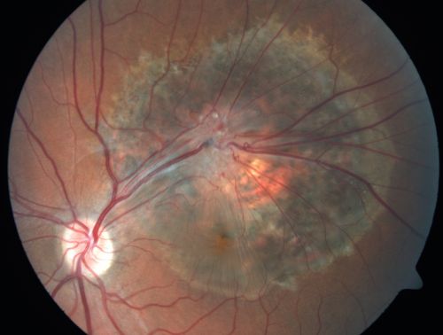 Malformación capilar de la retina