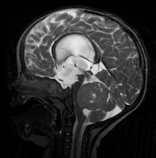 Meduloblastoma infantil