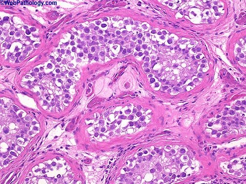 Meduloblastoma clásico