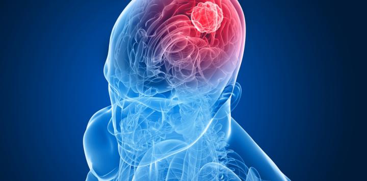 Meduloblastoma con nodularidad extensa