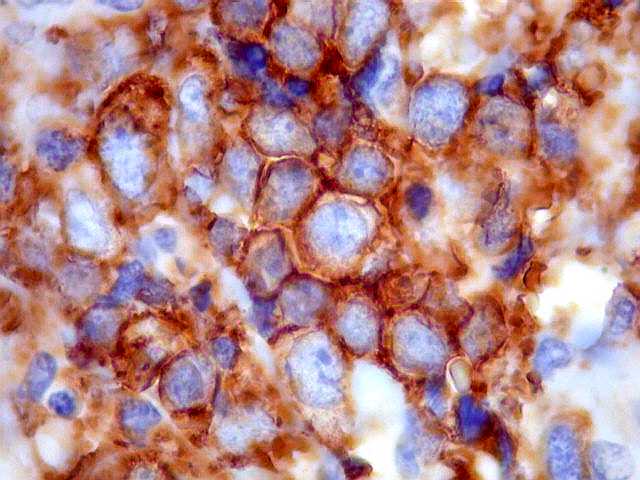 Meduloepitelioma del sistema nervioso central