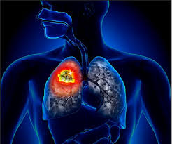 Mesotelioma pleural