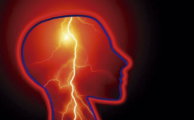 Microcefalia - epilepsia - deficiencia intelectual - cardiopatía