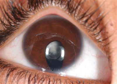 Microcórnea - glaucoma - ausencia de senos frontales