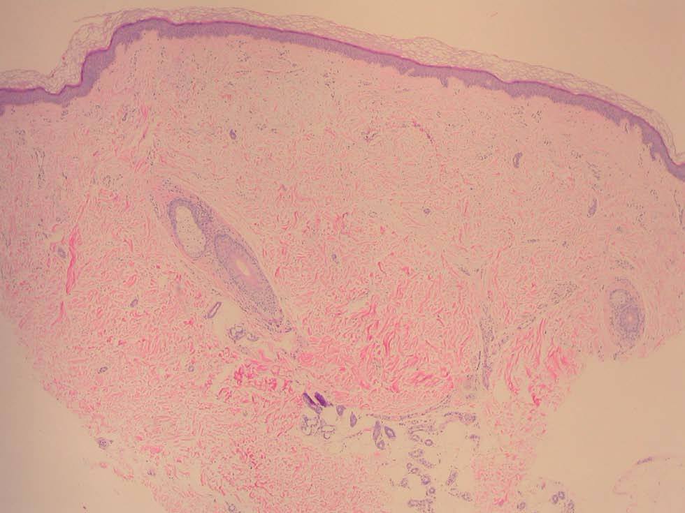 Mucinosis papular acra persistente