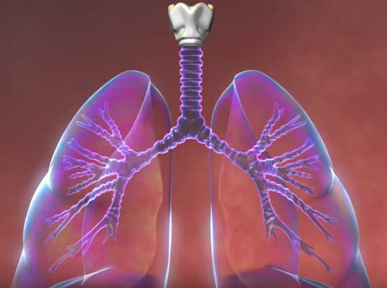 Neumonía eosinofílica crónica idiopática