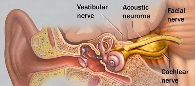 Schwannoma vestibular