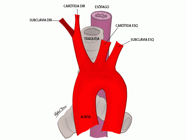 Anomalías del arco aórtico - dismorfismo - deficiencia intelectual