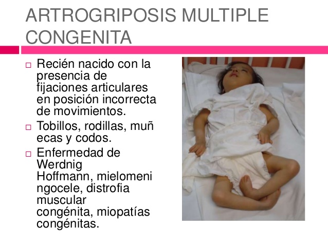 Artrogriposis múltiple congénita