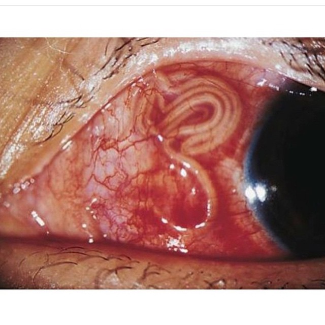 Oncocercosis