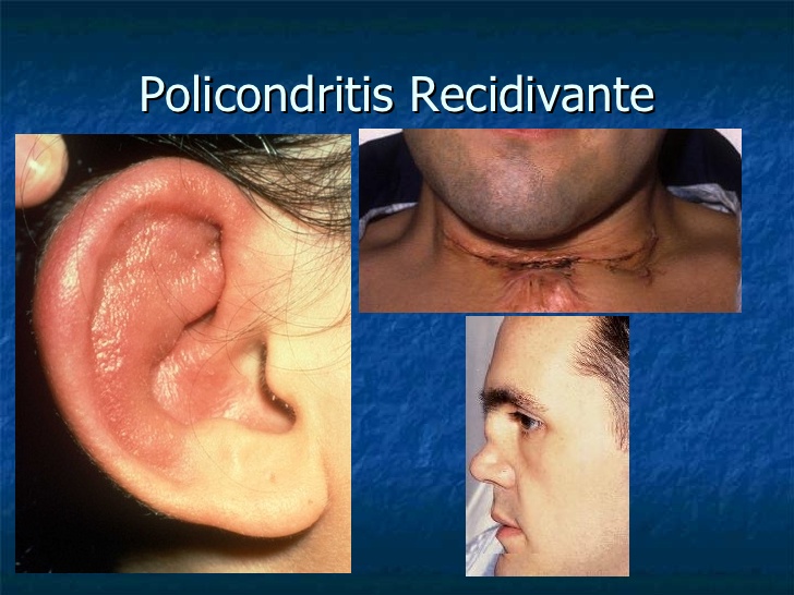 Policondritis recidivante