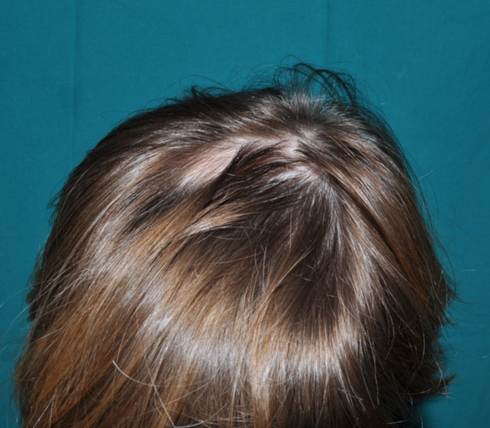 Síndrome similar al de Noonan con cabello anágeno caduco