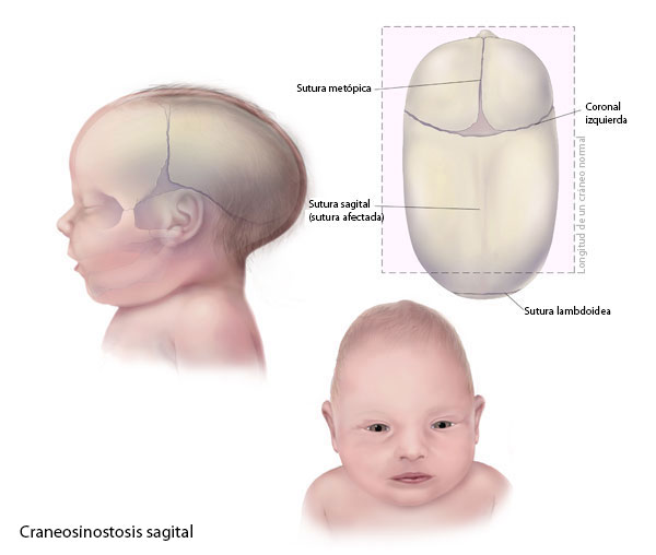 craneosinostosis