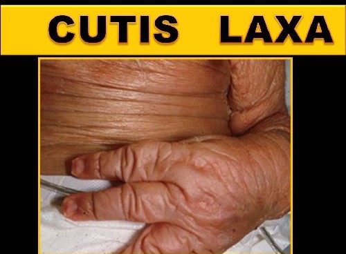 Cutis laxa