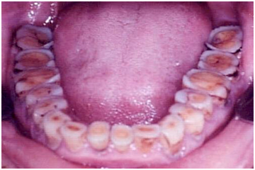 Dentinogénesis imperfecta - estatura baja - sordera - deficiencia intelectual