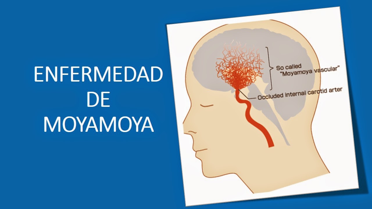 Enfermedad de Moyamoya