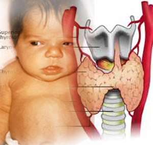 Hipotiroidismo congénito