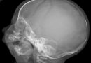 Síndrome cerebro-costo-mandibular
