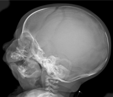 Síndrome cerebro-costo-mandibular