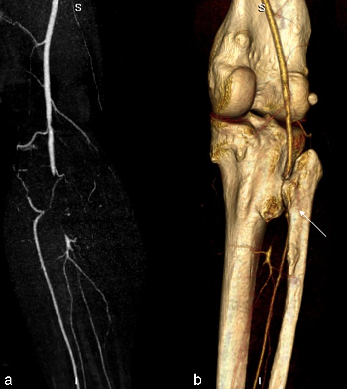 Síndrome de calcificación arterial y articular múltiple hereditaria