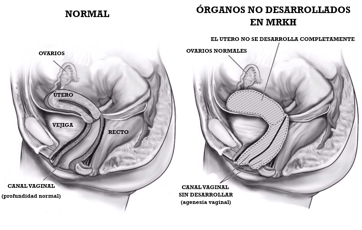 Síndrome de Mayer - Rokitansky - Küster - Hauser tipo 2