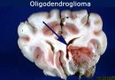 Tumor oligodendroglial