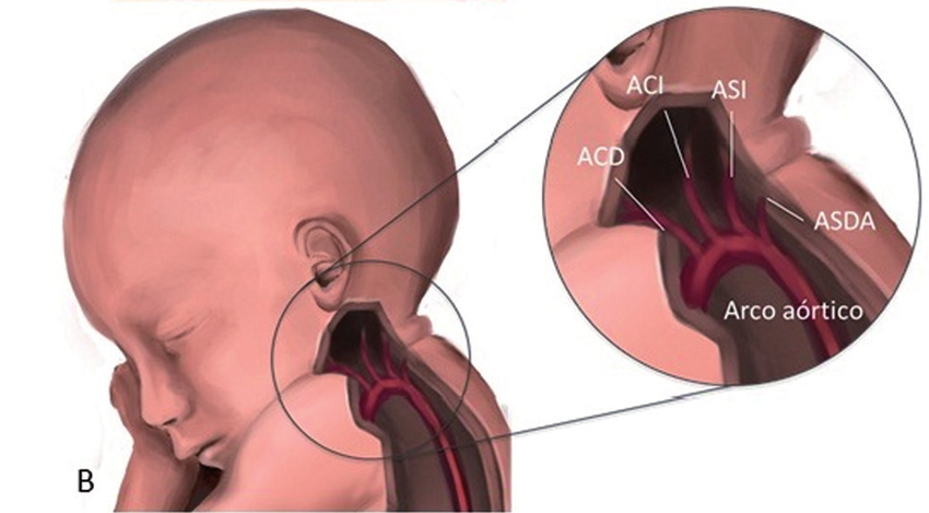 Anomalías del arco aórtico - dismorfismo - discapacidad intelectual