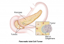 Tumor neuroendocrino pancreático
