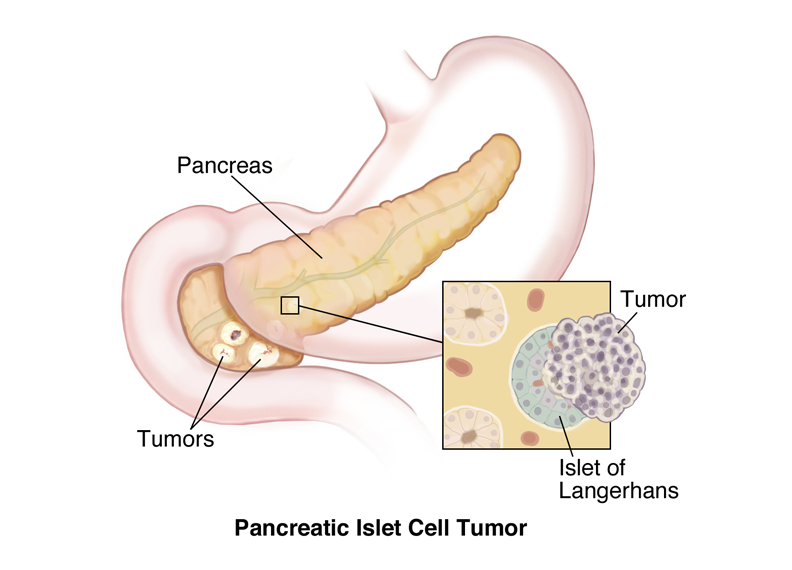 Tumor neuroendocrino pancreático