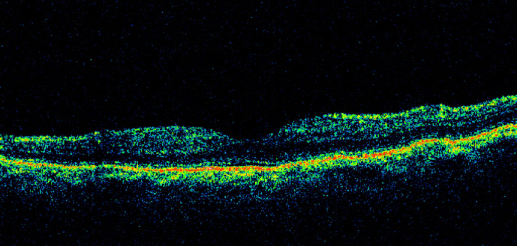 Atrofia coriorretiniana pigmentada paravenosa