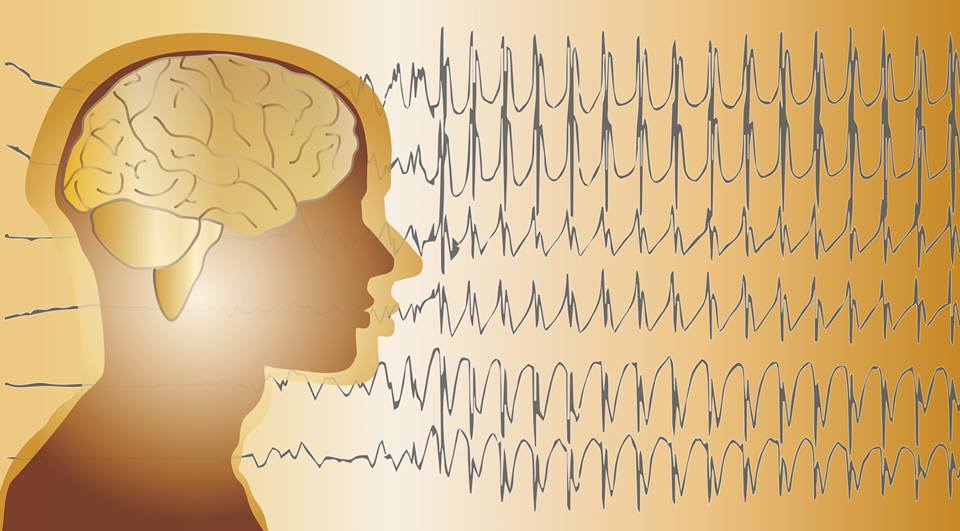 sindrome-Lennon-Gastaut-síndrome-Dravet