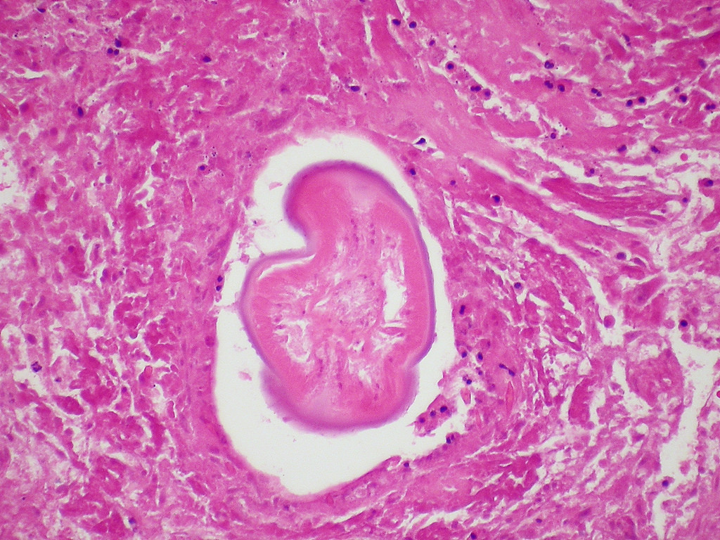 Dirofilariasis