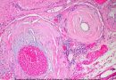 Amiloidosis inv
