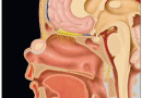 Heterotopia-glial-nasal