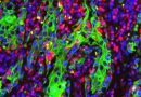 cutaneous-squamous-cell-carcinoma-1