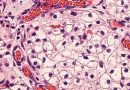 Carcinoma de células renales eerr
