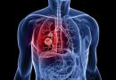 cancer-de-pulmon-de-celulas-pequenas-inmunoterapia
