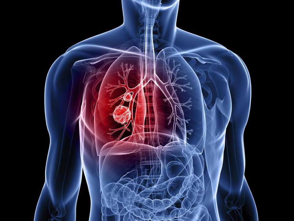cáncer de pulmón de células pequeñas, inmunoterapia