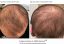 Alopecia eerr