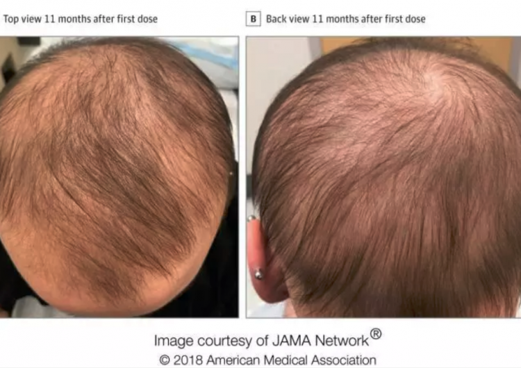 medicamento hace crecer el cabello a pacientes con alopecia