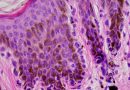 Lentiginosis-generalizada-familiar
