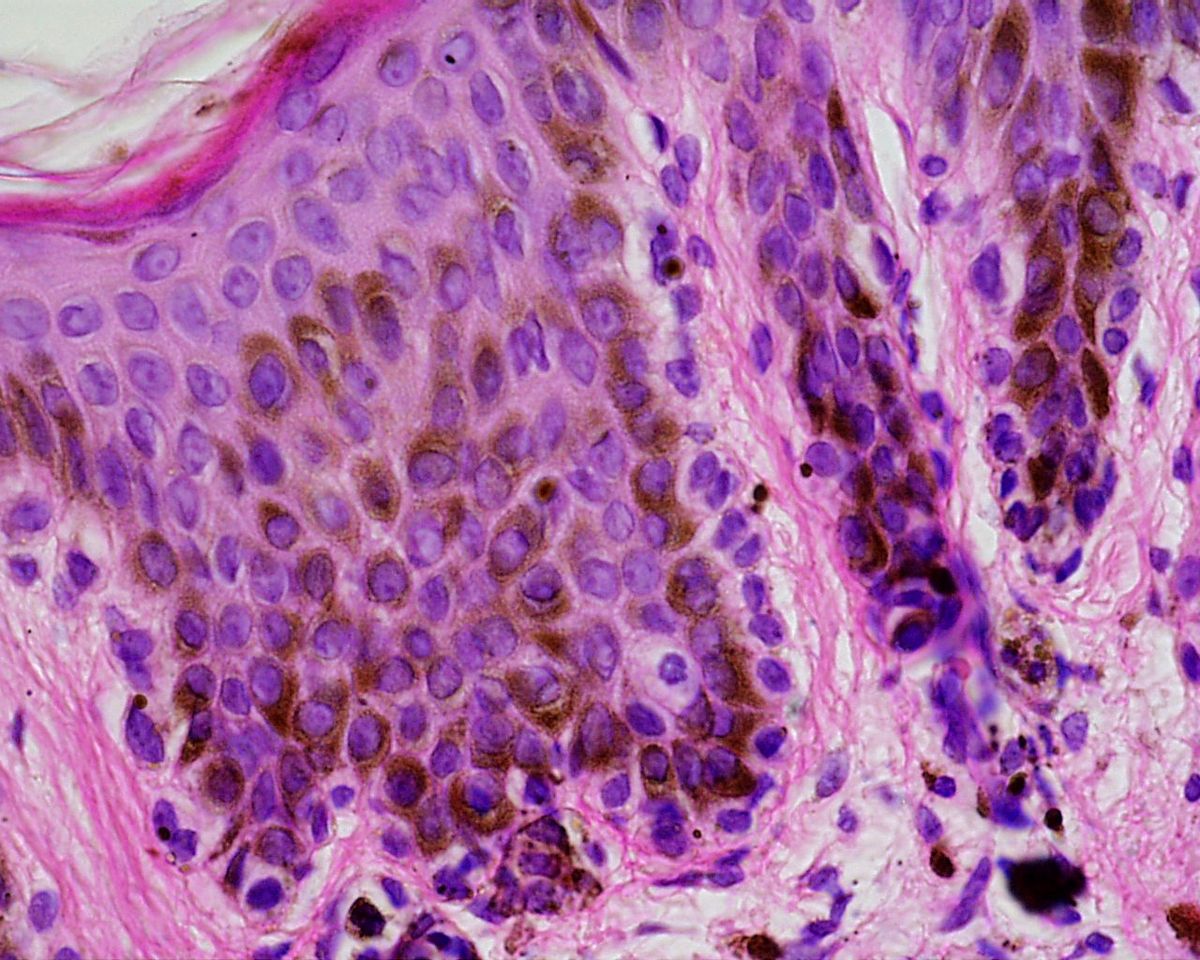 Lentiginosis generalizada familiar