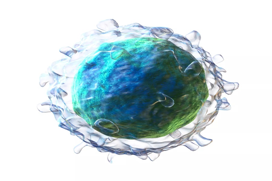 Linfoma nodal de zona marginal de células B