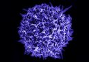 Linfoma-primario-cutaneo-agresivo-epidermotropico-de-celulas-T-CD8